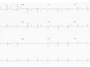 ECG