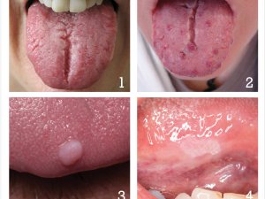 Tongue disease