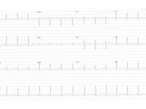ECG