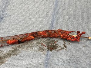 Blood clots in the ClotReiver CR Inari Medical