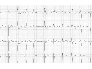 ECG