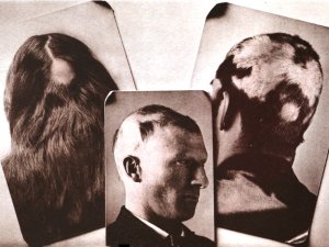 Alopecia areata