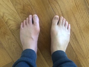 Gout