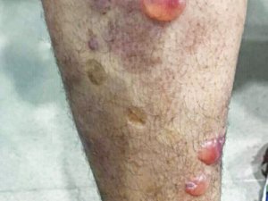 skin lesions become blisters