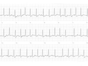 Heartbeat ECG
