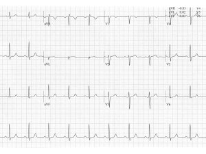 Heartbeat