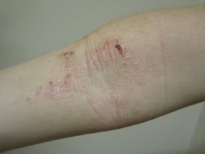 Eczema