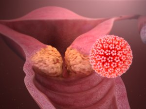 HPV_Cervical Cancer_CR_scientificanimations