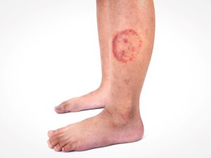 Ringworm infection Tinea corporis