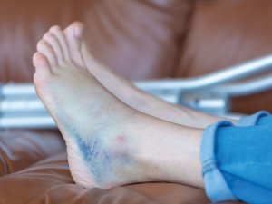 Bruised broken foot sprained ankle