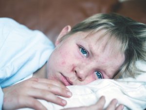 Boy with measles