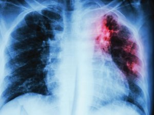 Pulmonary Tuberculosis CR iStock