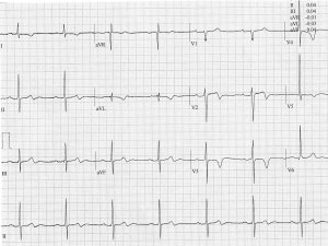 ECG Apr 2025