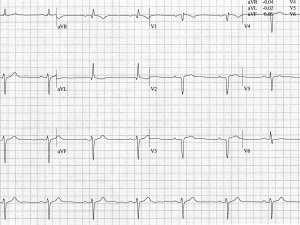 Heartbeat-ECG-Jun-2025