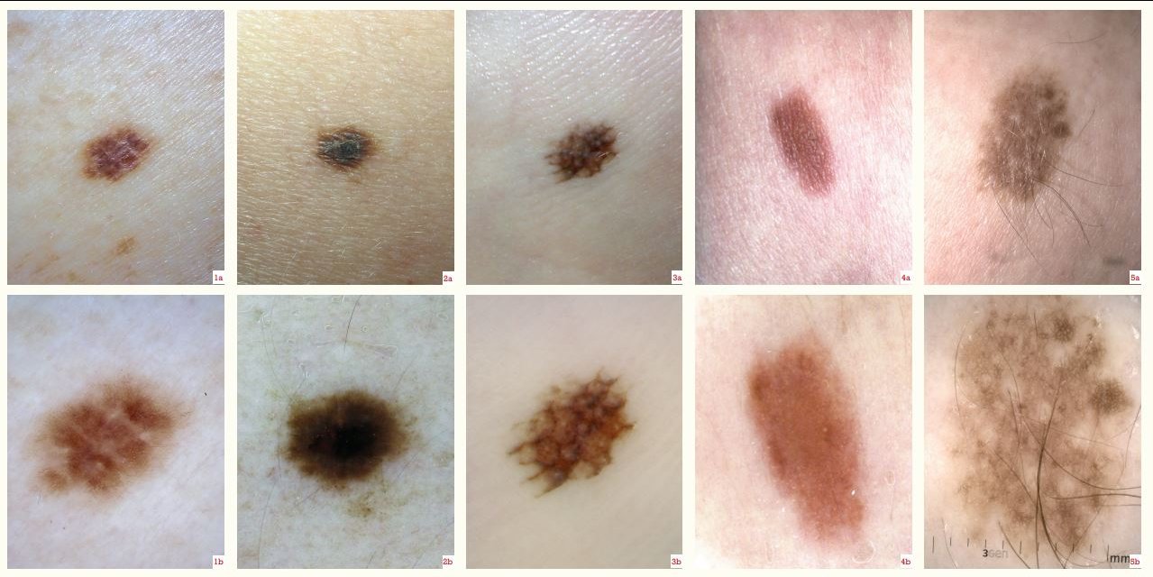 Dermatoscopic examination 1