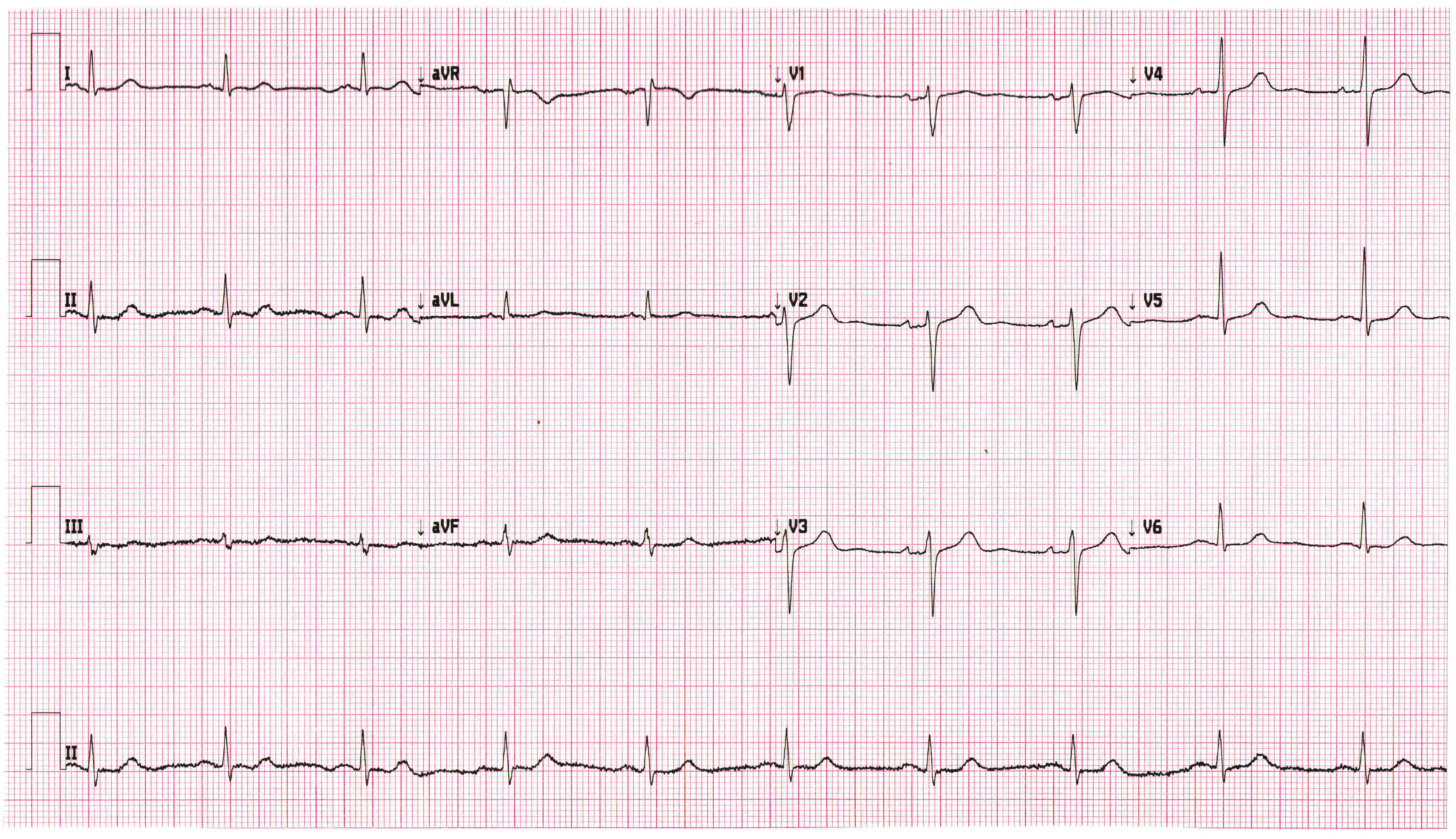 Heartbeat 