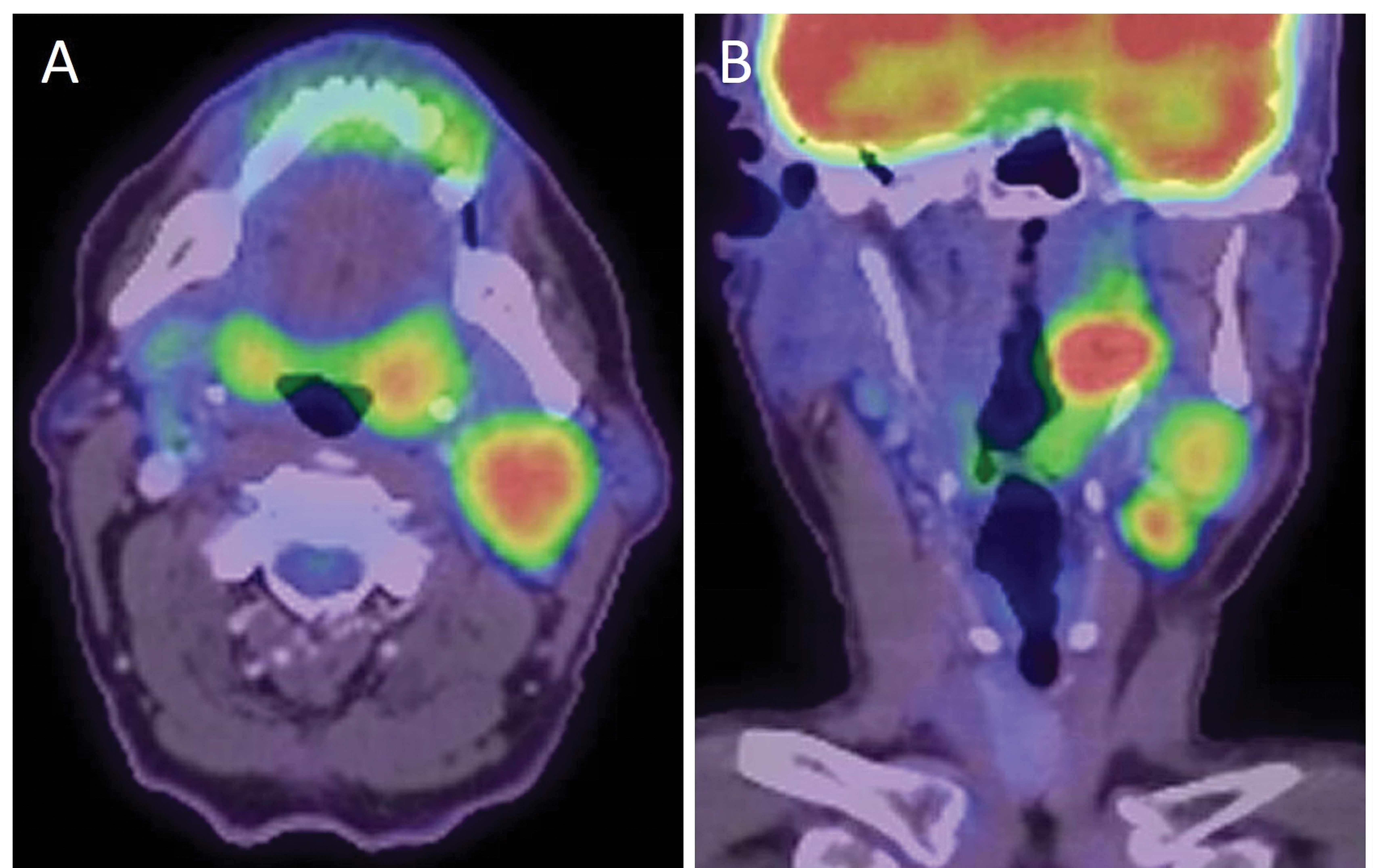 Figure 1. Axial (A) and coronal (B) PET-CT showing HPV-positive oropharyngeal squamous cell carcinoma affecting the left tonsil with metastases in the neck