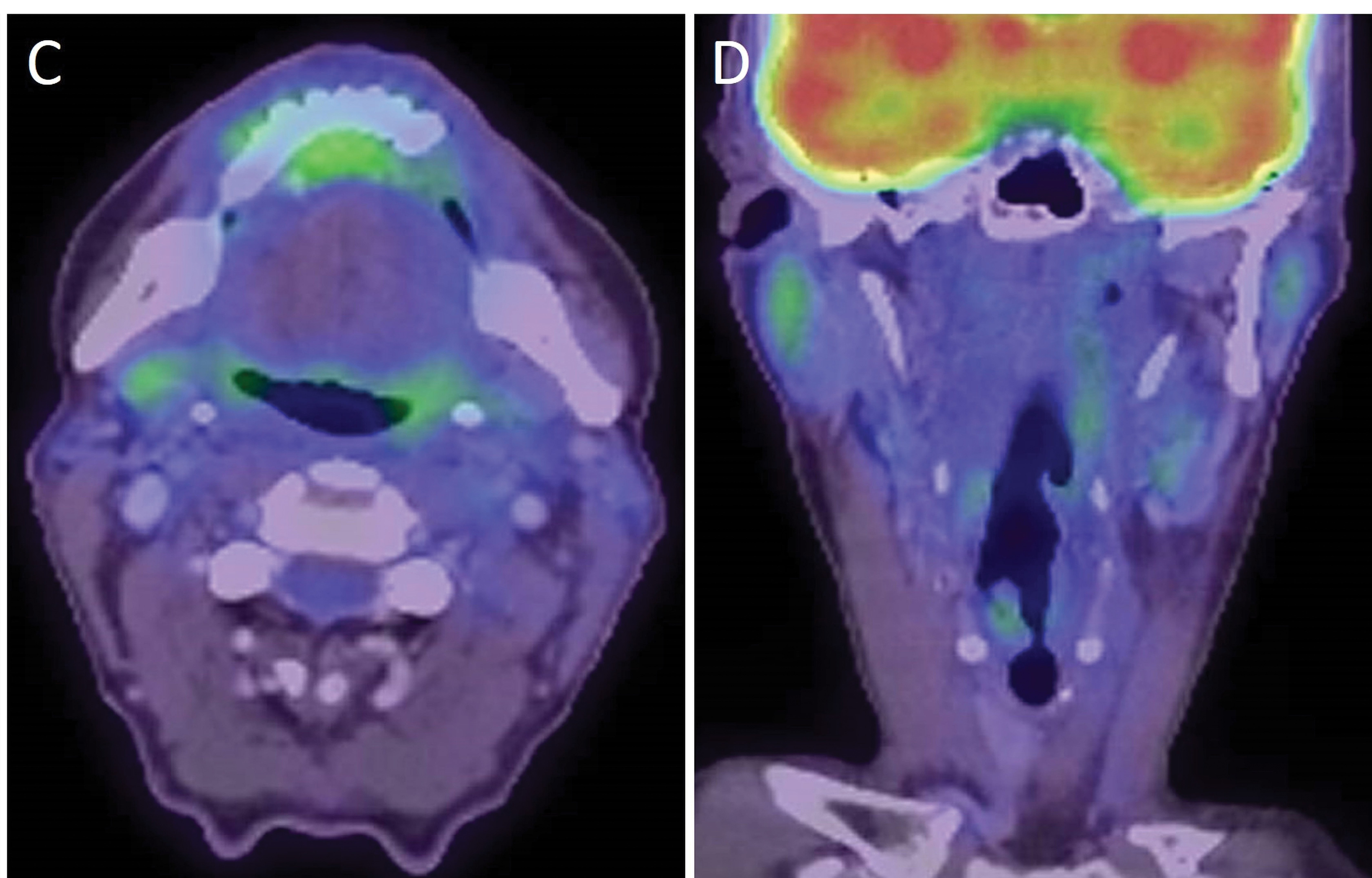 Figure 2. Post-treatment axial (A) and coronal (B) PET-CT of the same patient 