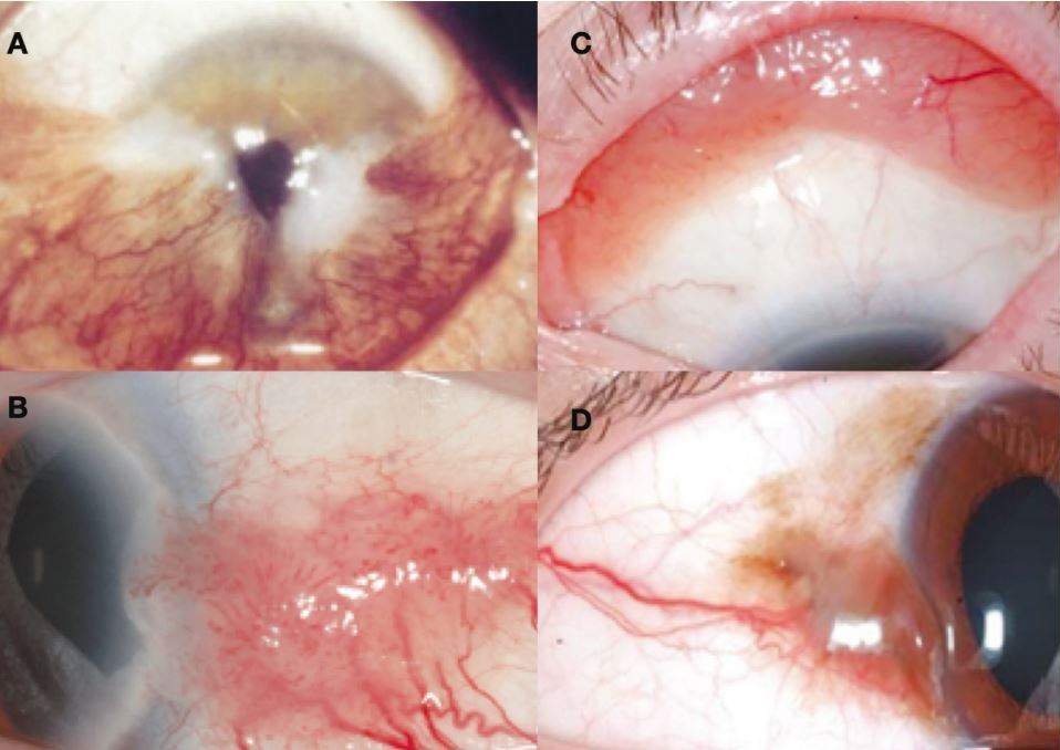 Pterygium-like lesions