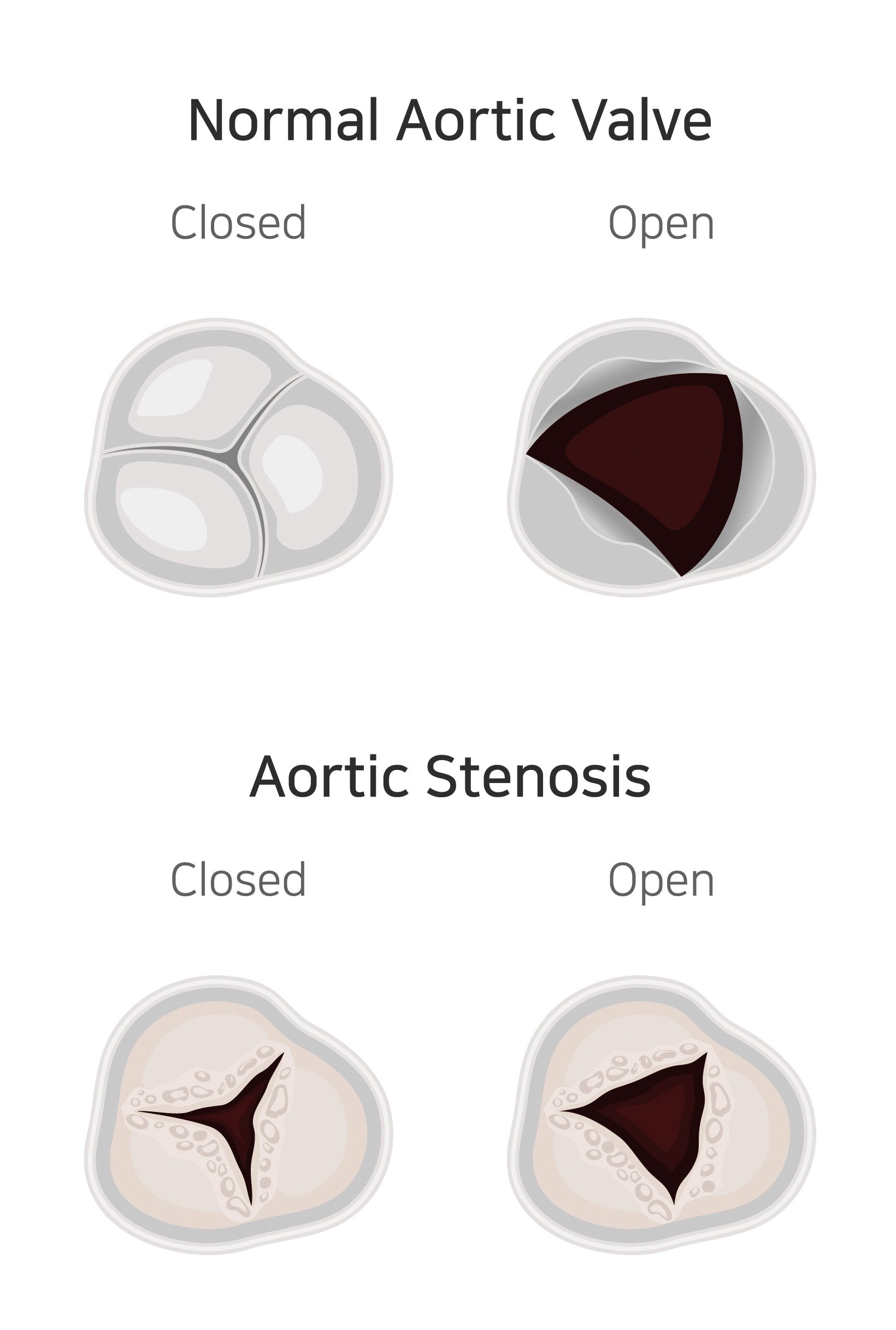 Figure 1. In people with aortic stenosis, calcification and restriction of the aortic valve causes the heart to work harder to pump blood into the aorta