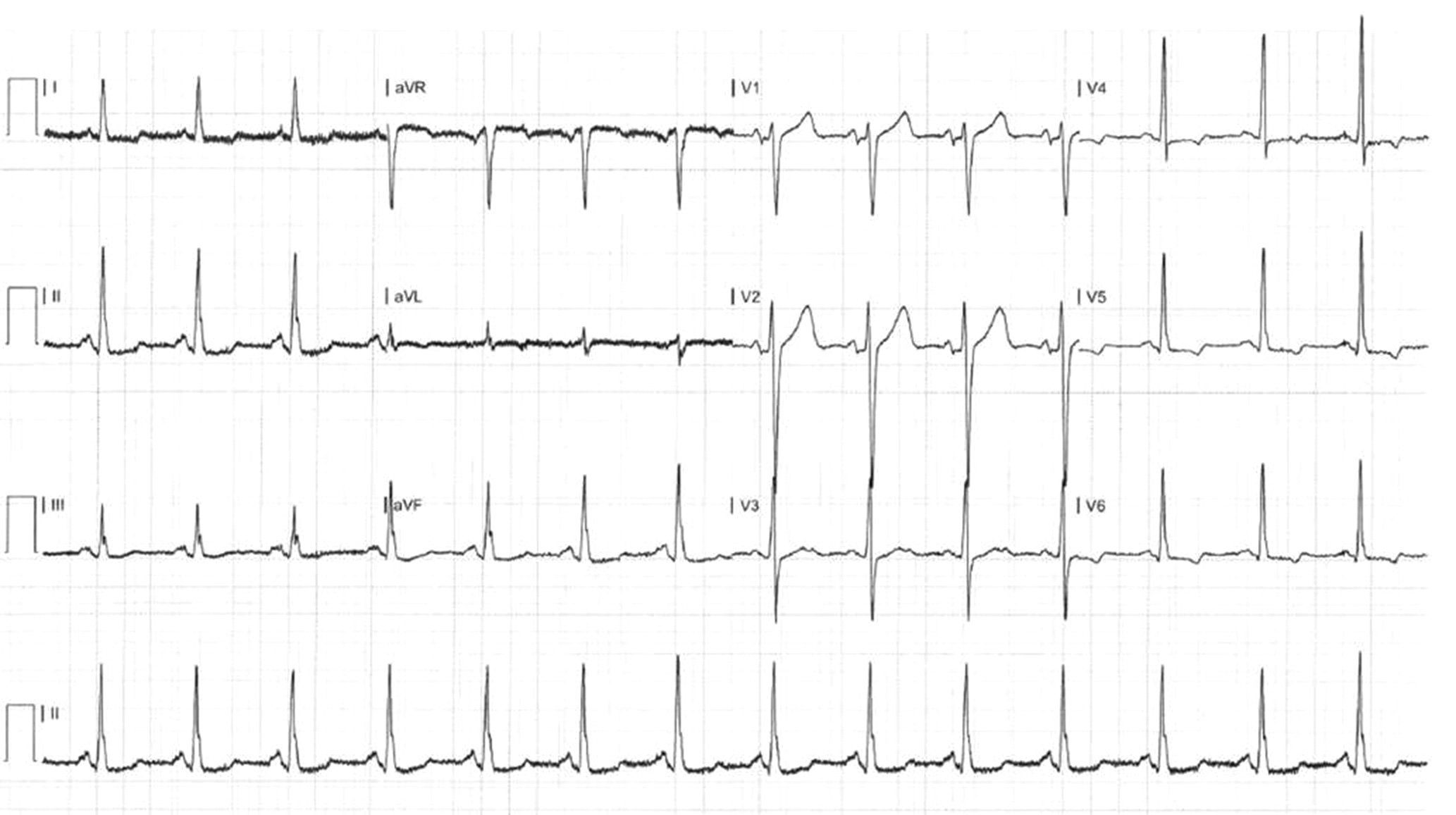 Figure 2. Electrocardiogram showing left ventricular hypertrophy and left ventricular strain – key findings are large R waves and asymmetric T­wave inversion in leads V5 and V6