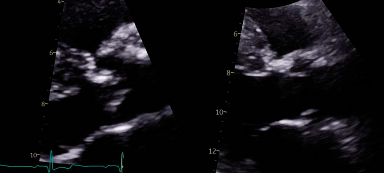Figure 3. Echocardiogram showing a thickened, calcified and restricted aortic valve (left). A normal valve is shown for reference (right)