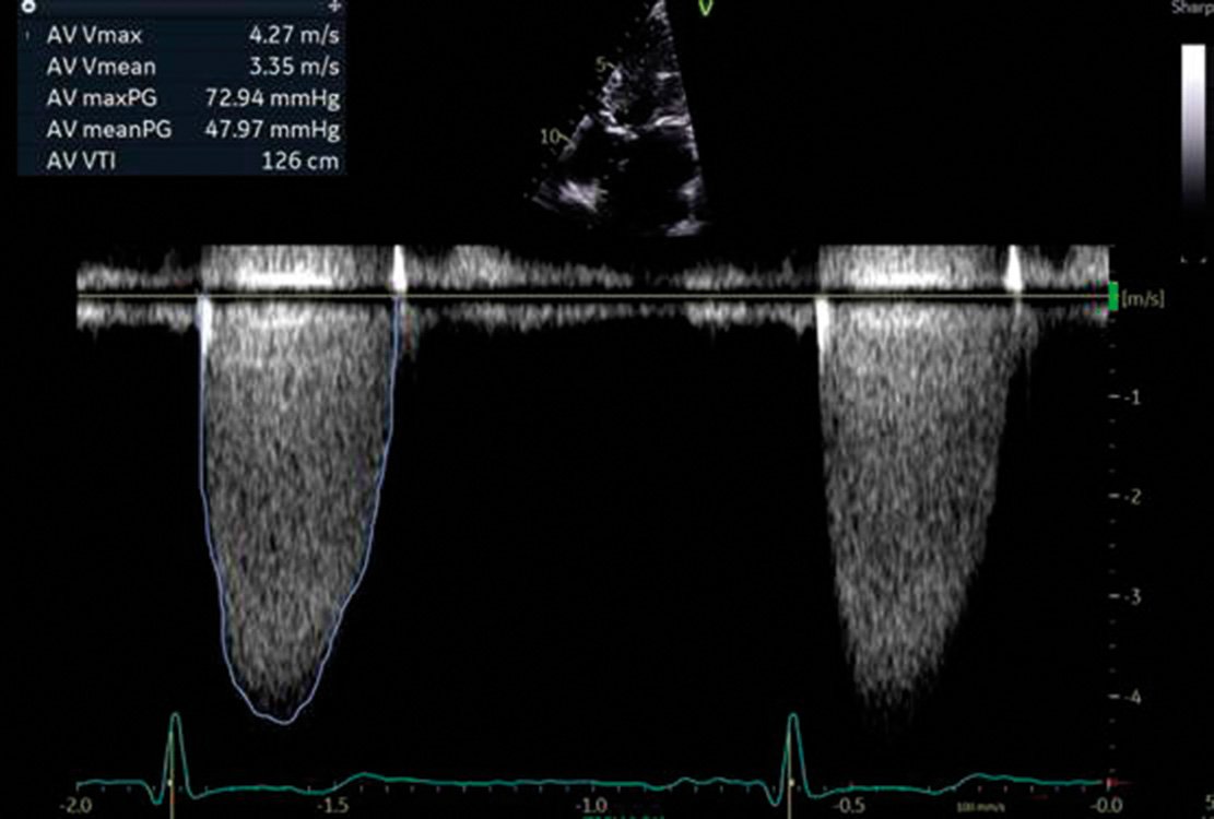 Figure 4. Continuous­wave Doppler trace showing the peak velocity of blood through the valve (4.3m/s), as well as the mean gradient across the valve (48mmHg), derived from the area under the curve