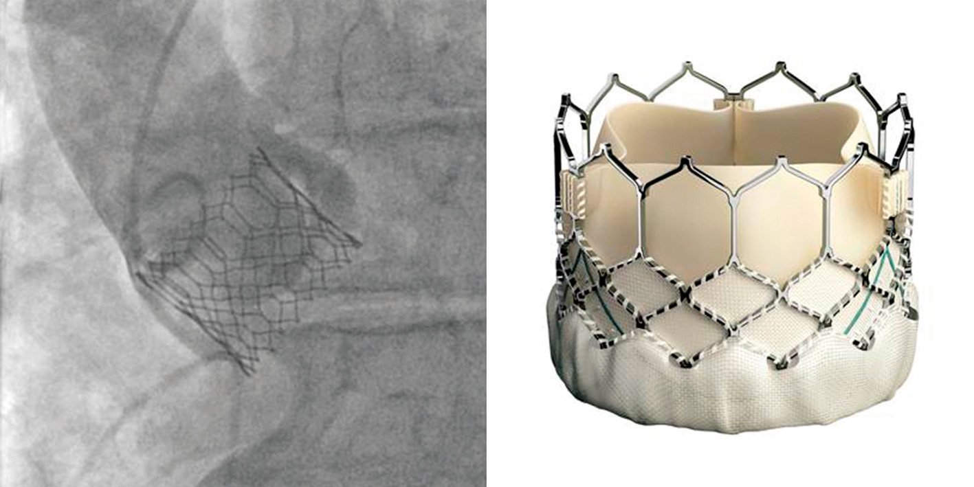 Figure 5. The SAPIEN 3 transcatheter heart valve(Courtesy Edwards Lifesciences)