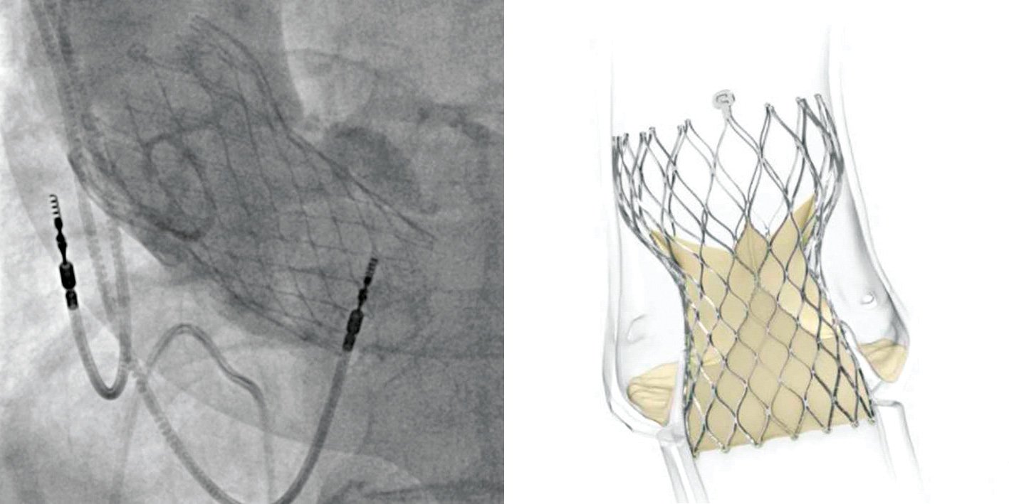 Figure 6. The Evolut transcatheter heart valve(Courtesy Medtronic)