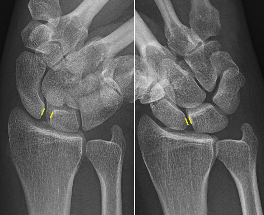 Wrist X-ray