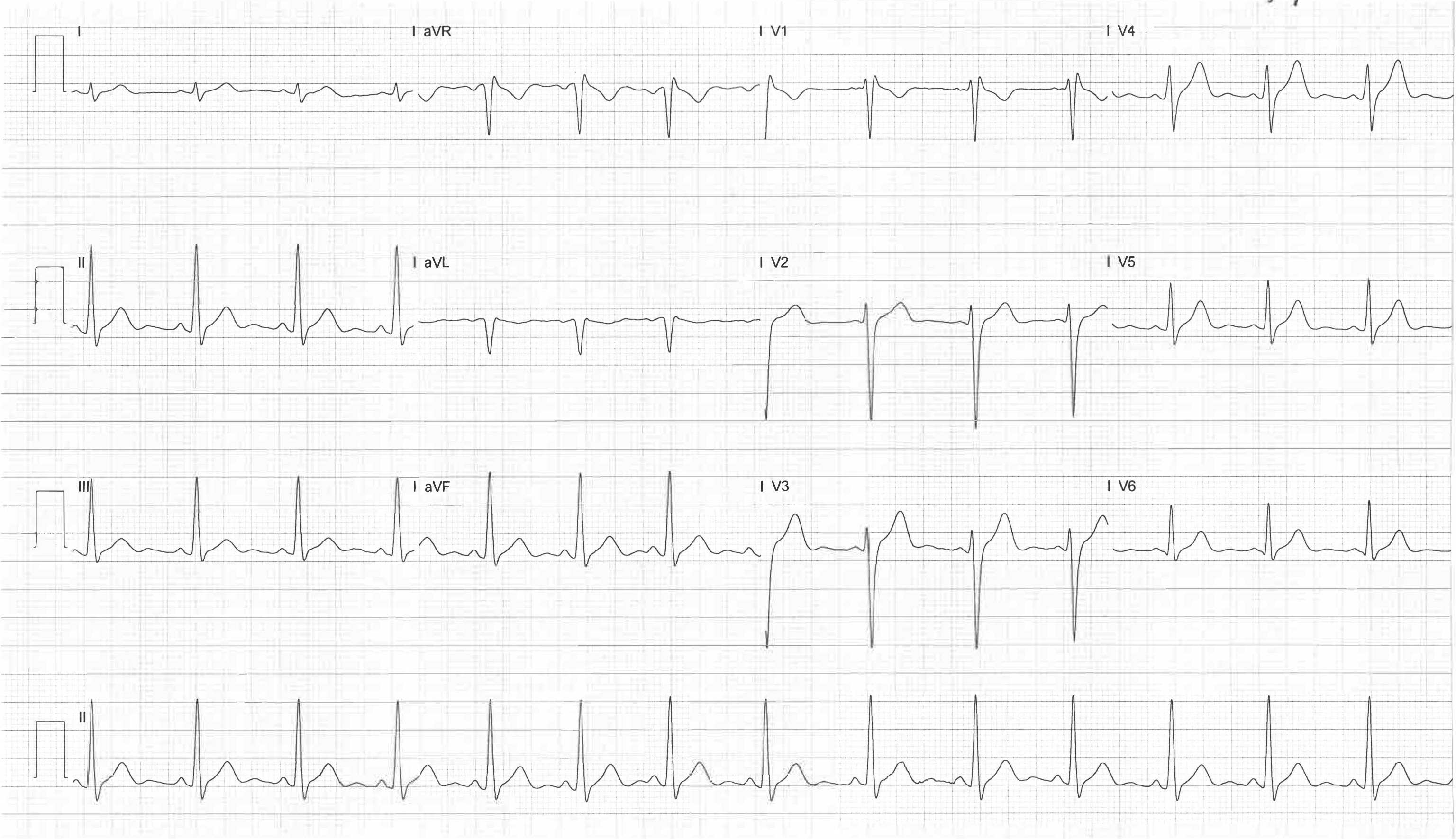 ECG