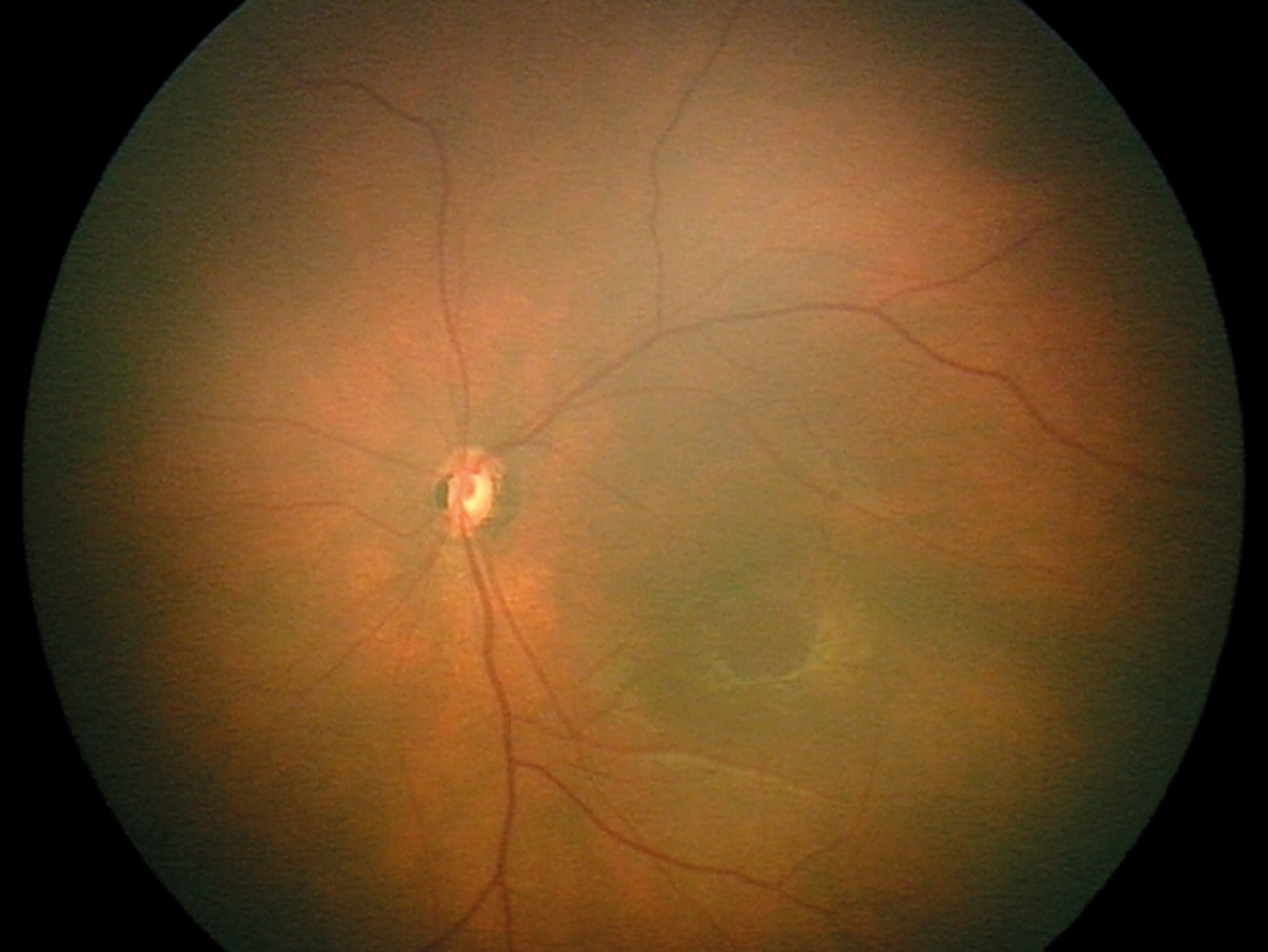 Figure 3. Optic nerve hypoplasia – a small optic nerve with a hypopigmented surrounding ring (the double-ring sign) (Supplied)