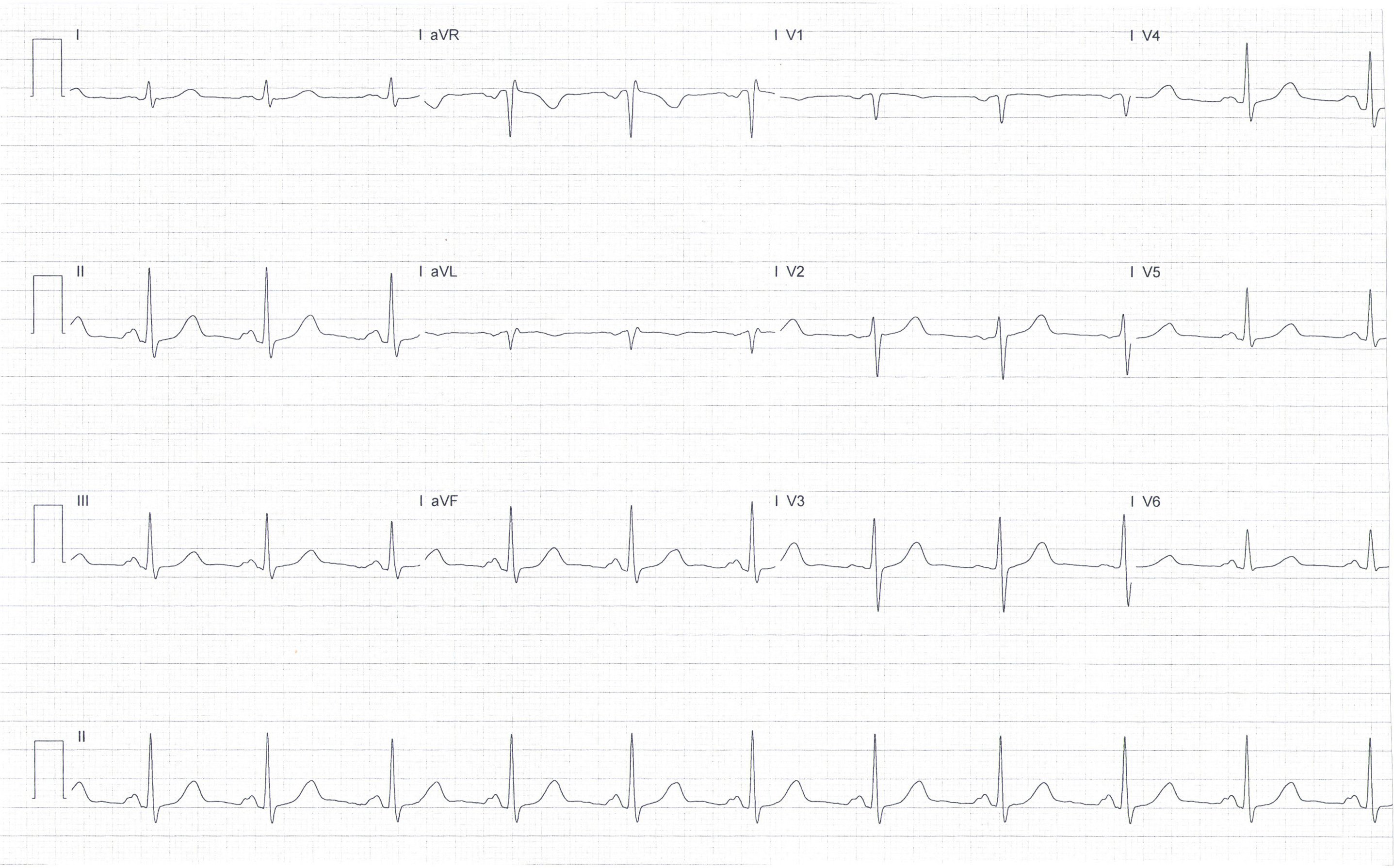 Heartbeat ECG