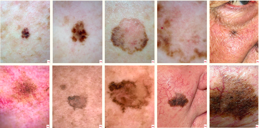 Melanoma