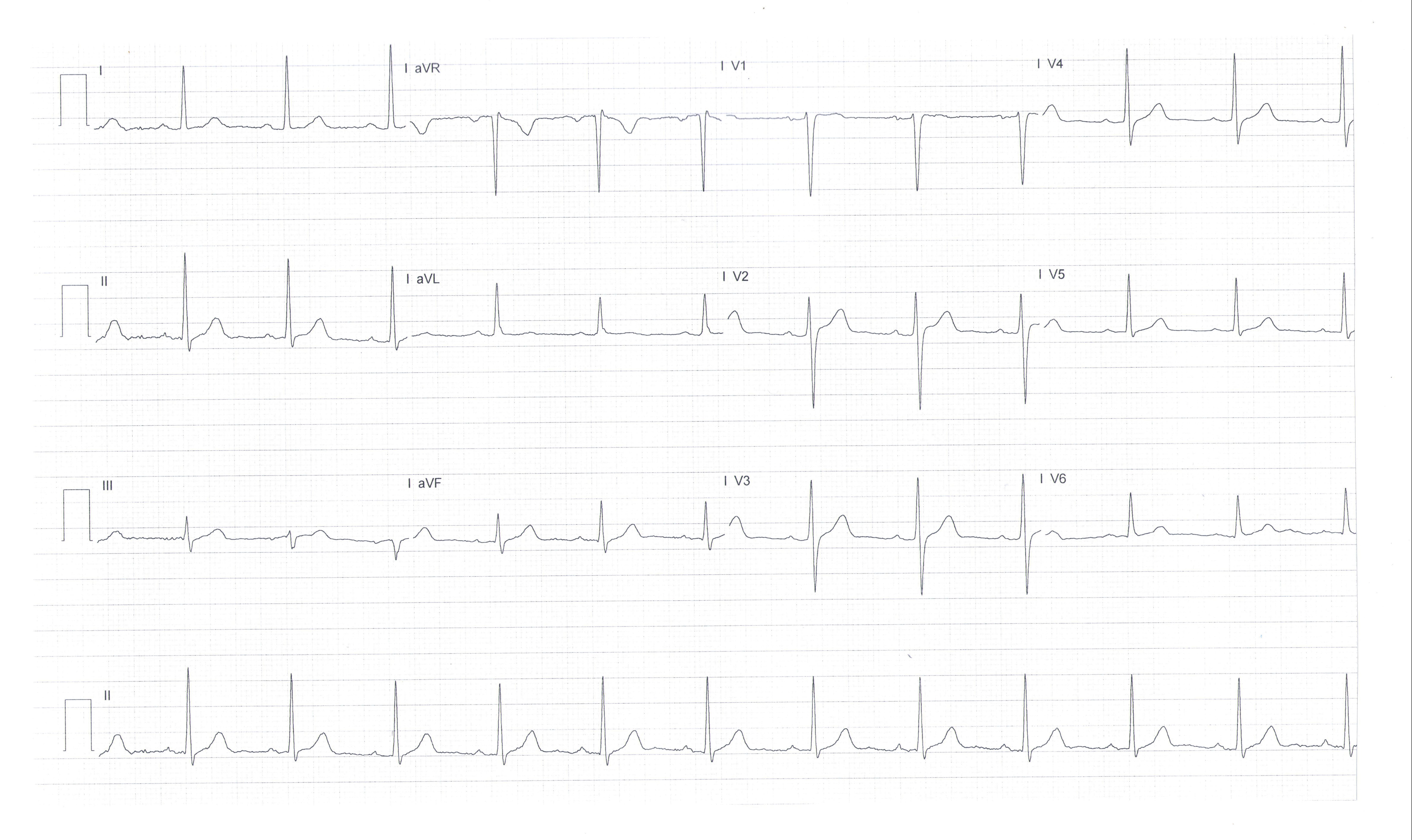 ECG