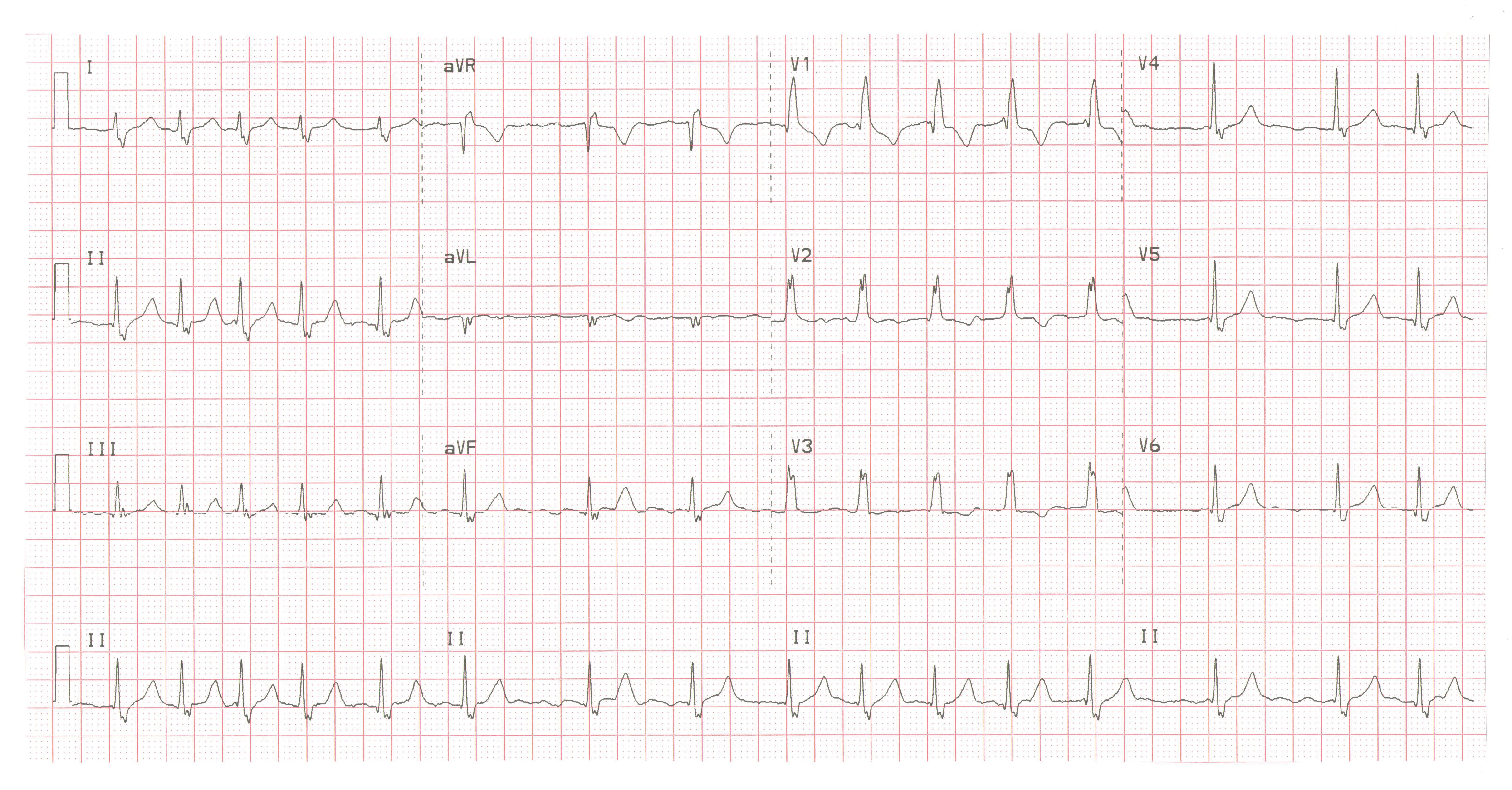 ECG
