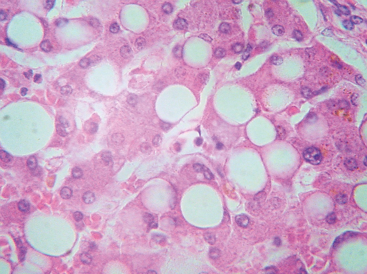 HTT Fatty liver figure 1
