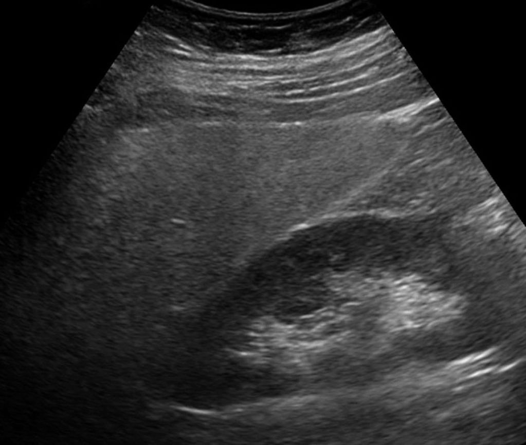 HTT Fatty liver figure 3