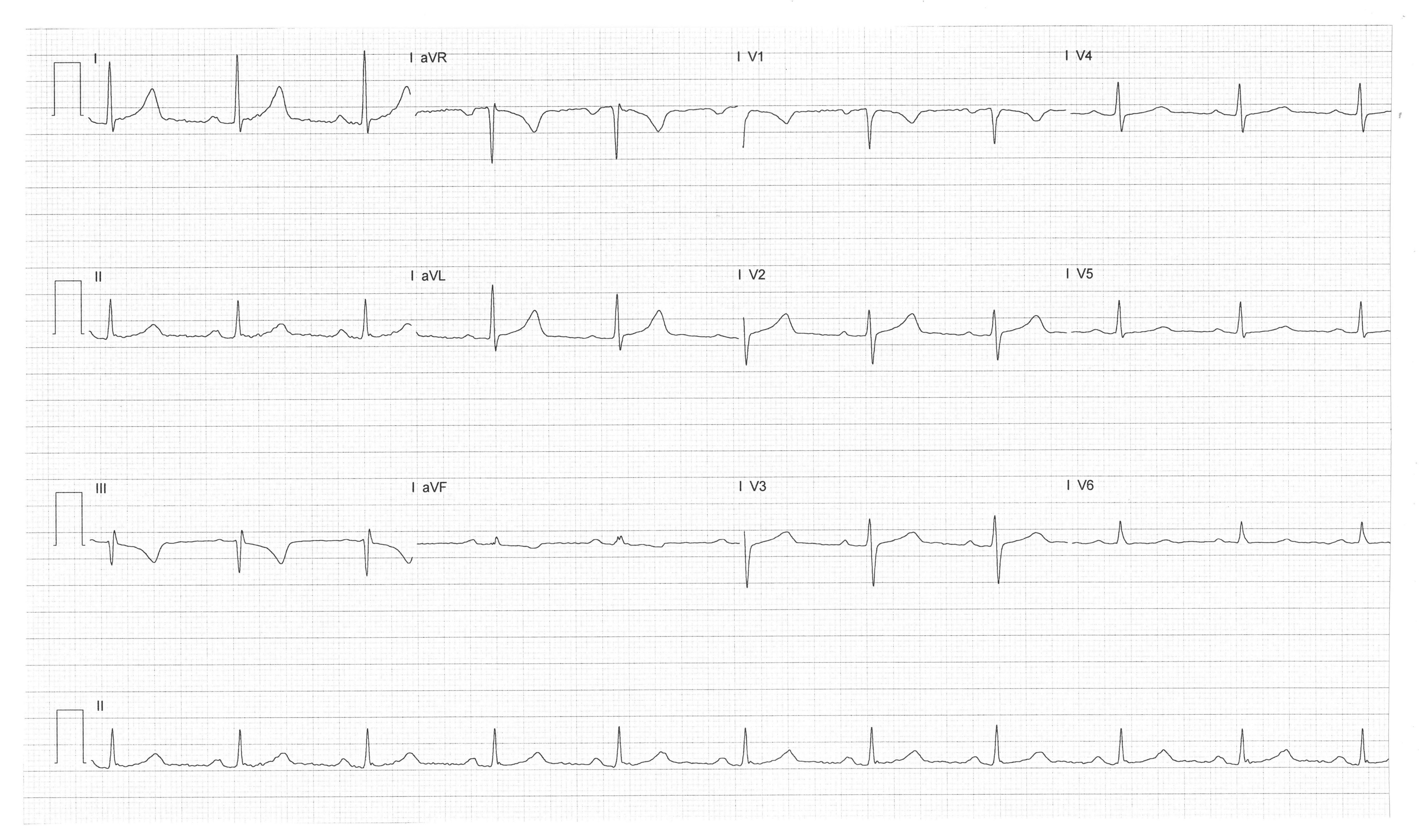 ECG