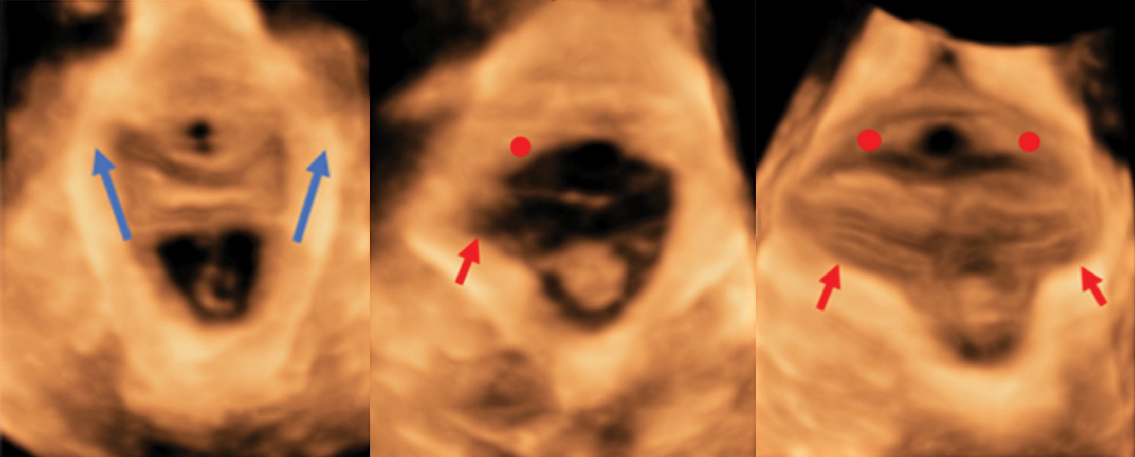 HTT Ultrasound