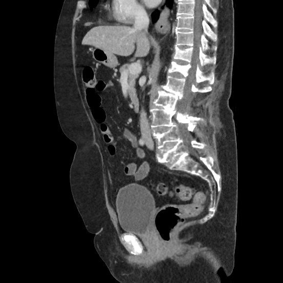 CT scan
