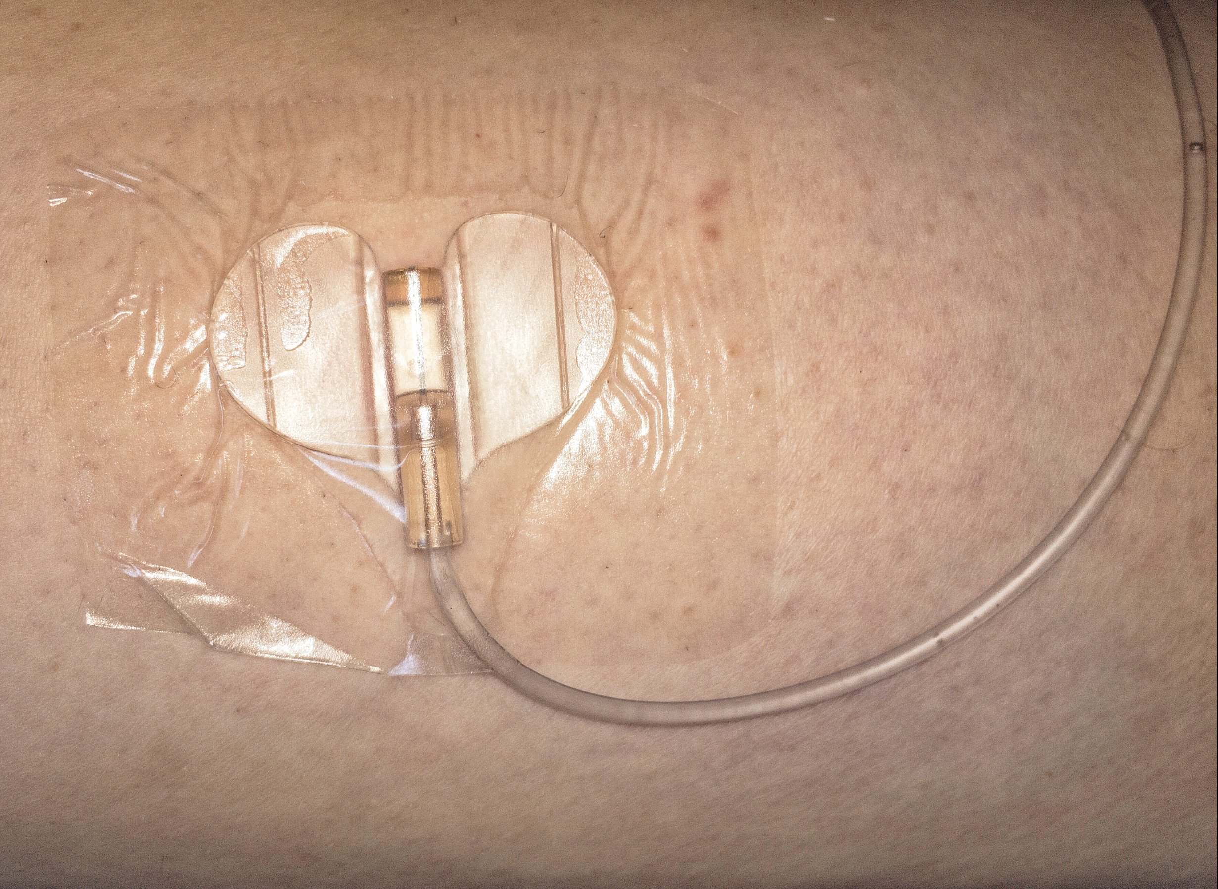 Medicine-cannula