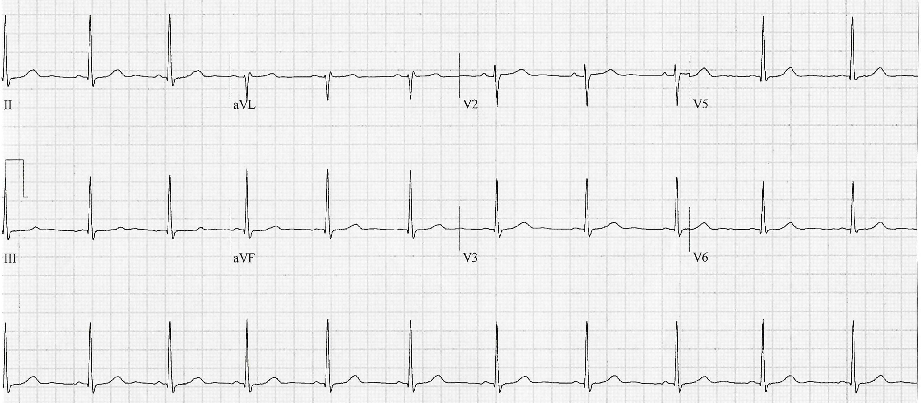 Heartbeat ECG 23 Oct 2024